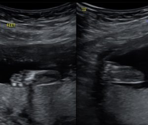 baby boy ultrasound